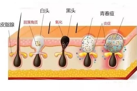 毛孔肌肤粗大怎么解决